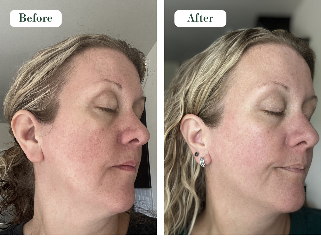 MAGI-C + RE-HYDRA 30-day result
